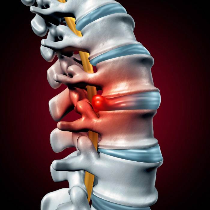 How to Seek Out Proper Treatment for a Herniated Disc