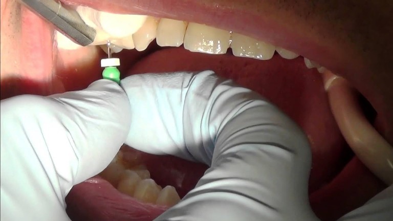 Root Canal Treatment